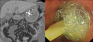 ダンベル型大口径金属ステントを用いた経胃的超音波内視鏡下膵膿痬ドレナージ